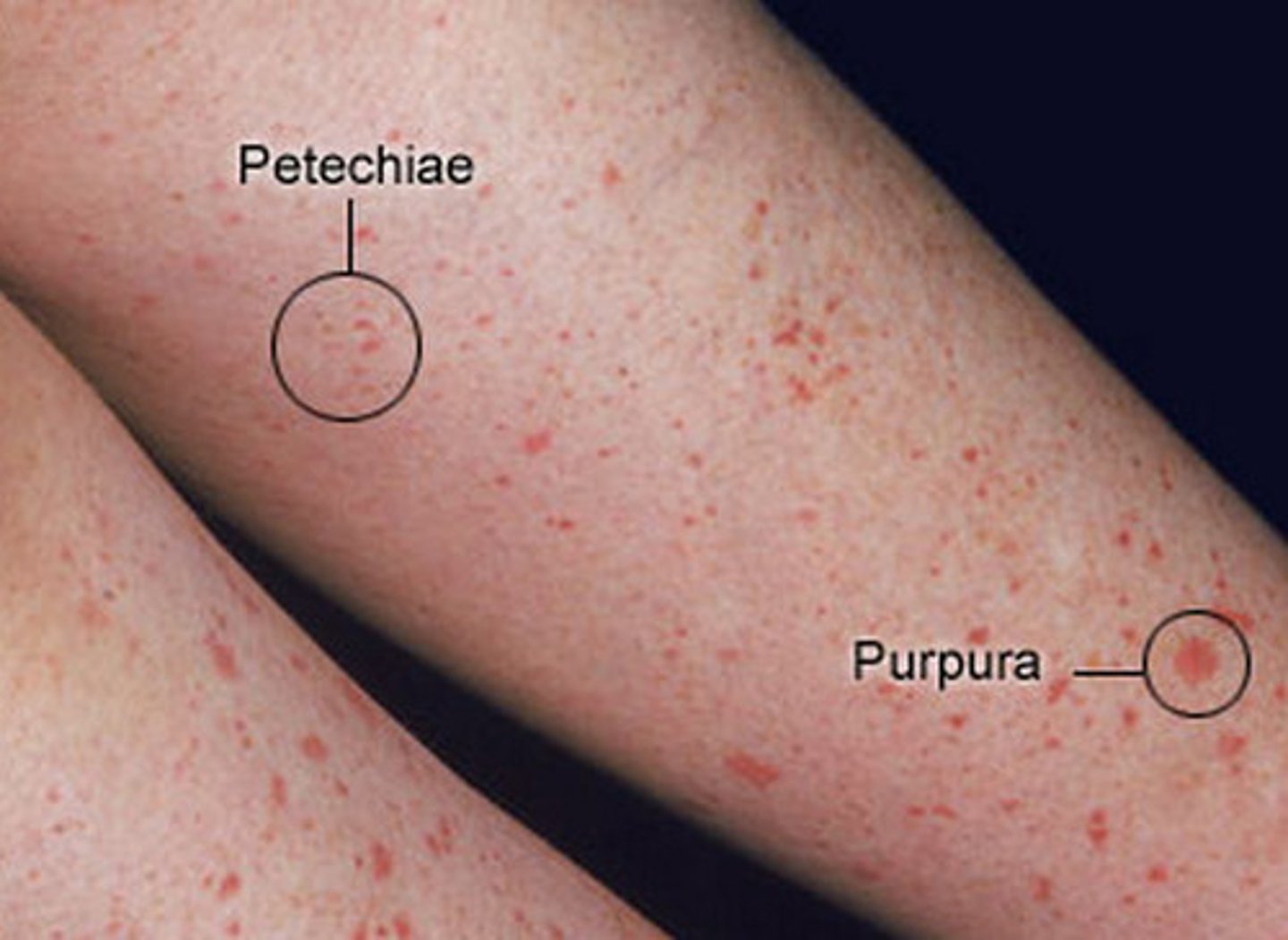 <p>small haemorrhaging (3-10mm diameter) but bigger than petechiae</p><p>due to vasculitis or trauma.</p>
