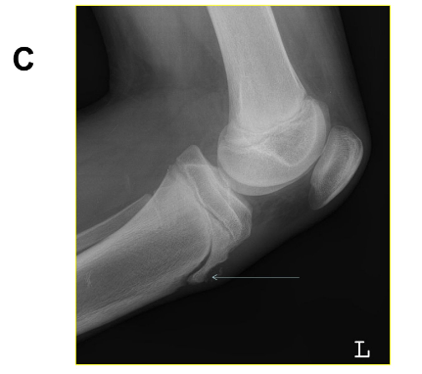 <p>What pathology is visualized on this image?</p>
