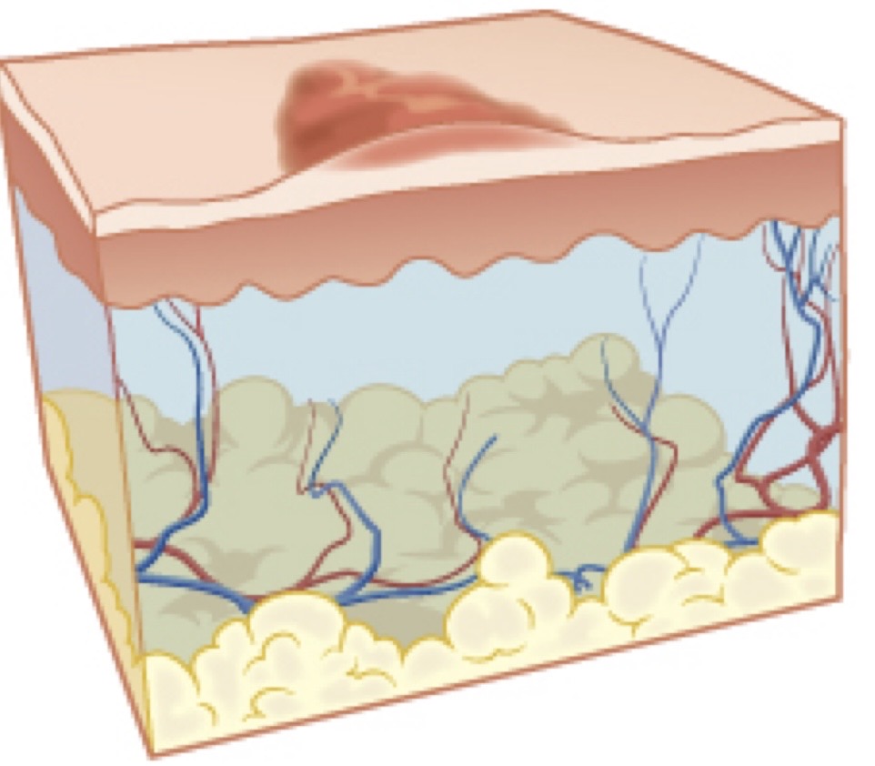 <p>Dry, raised area cover with a crust or scab</p>