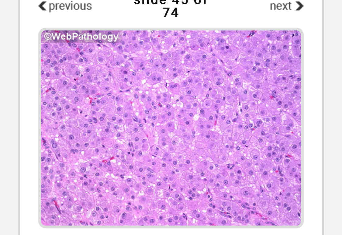 <p>What is steroid cell tumour ?</p>