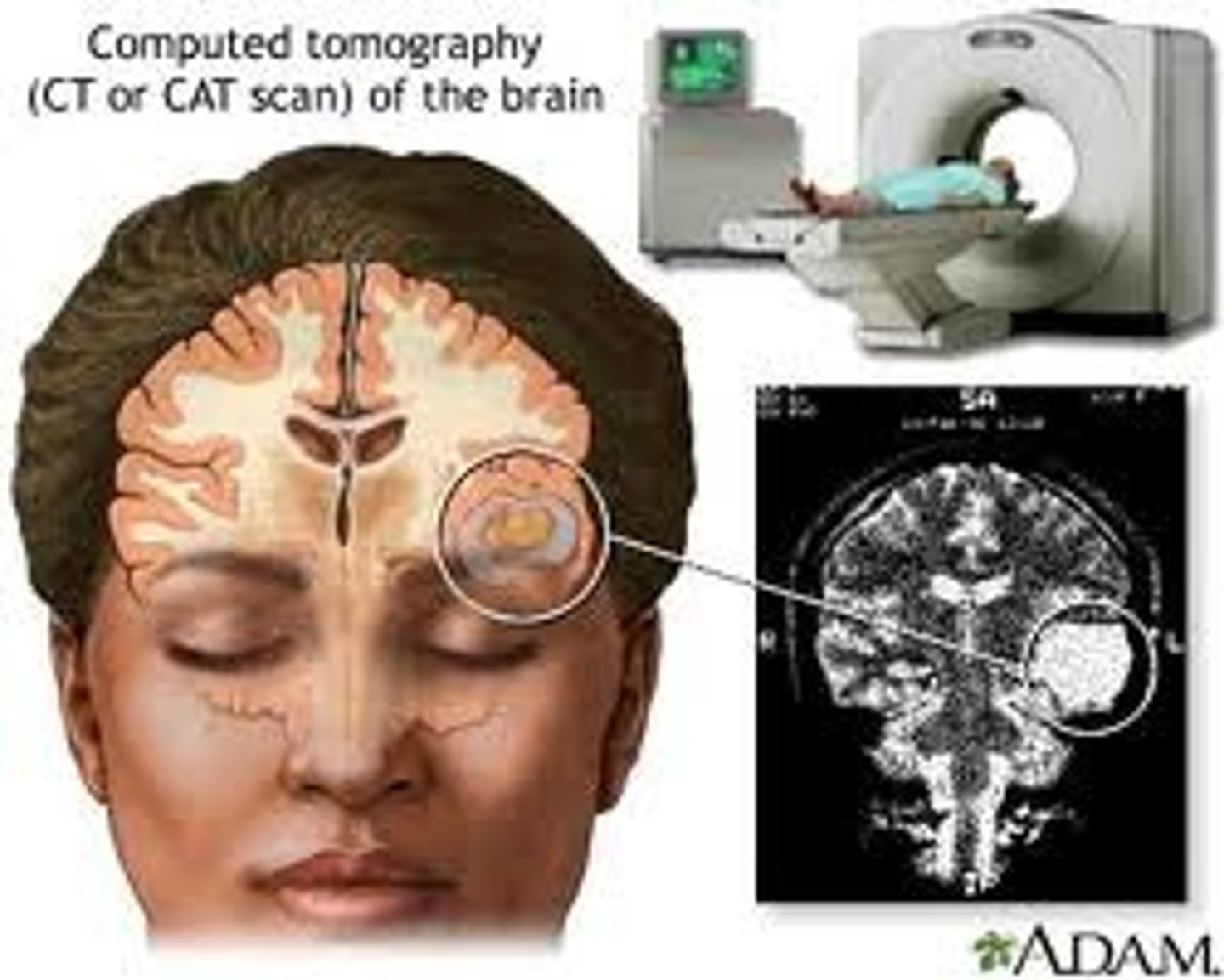<p>X-ray tube &amp; film move synchronously around a focal point</p><p>-Objects in focal point remain in focus, other aspects are blurred</p><p>-Images are slices of the area scanned</p><p>-Useful in evaluating lungs, kidneys, &amp; bony structures</p>