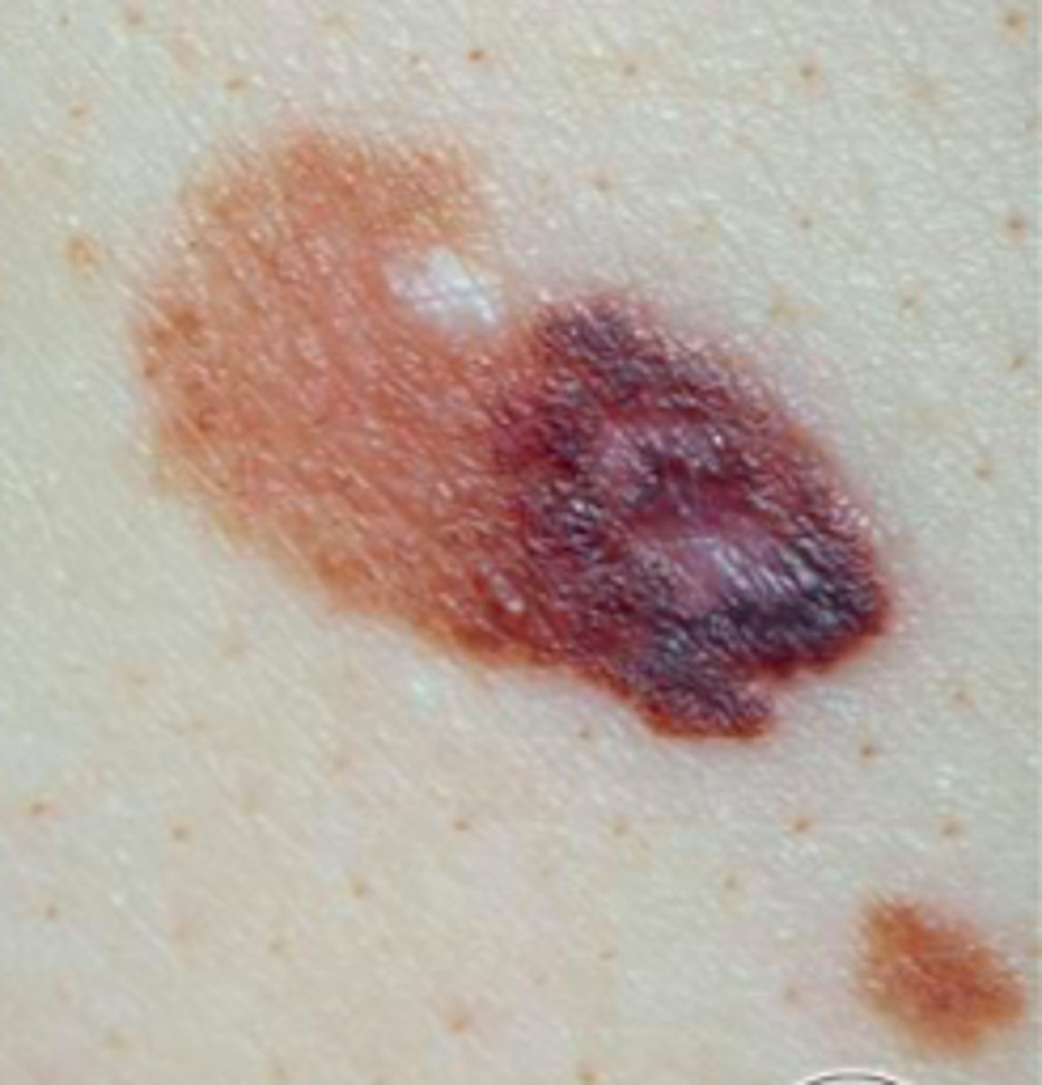 <p>Most common type of melanoma </p><p>Growth of tumor is horizontal rather than vertical (deep) into skin</p><p>Back on men </p><p>Back and legs on women</p>