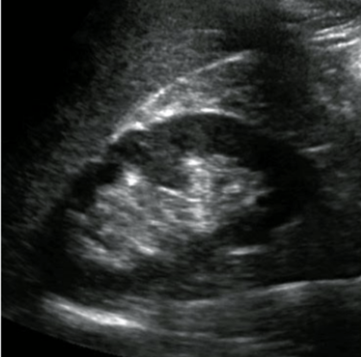 <p>What normal variant of the kidney may mimic a renal mass or duplicated urinary system?</p>