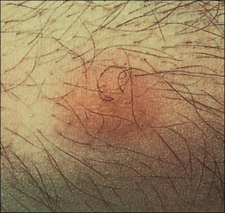 <p>TYPE 3 HYPERSENSITIVITY</p><p>Causes cutaneous vasculitis from various foreign antigens</p>