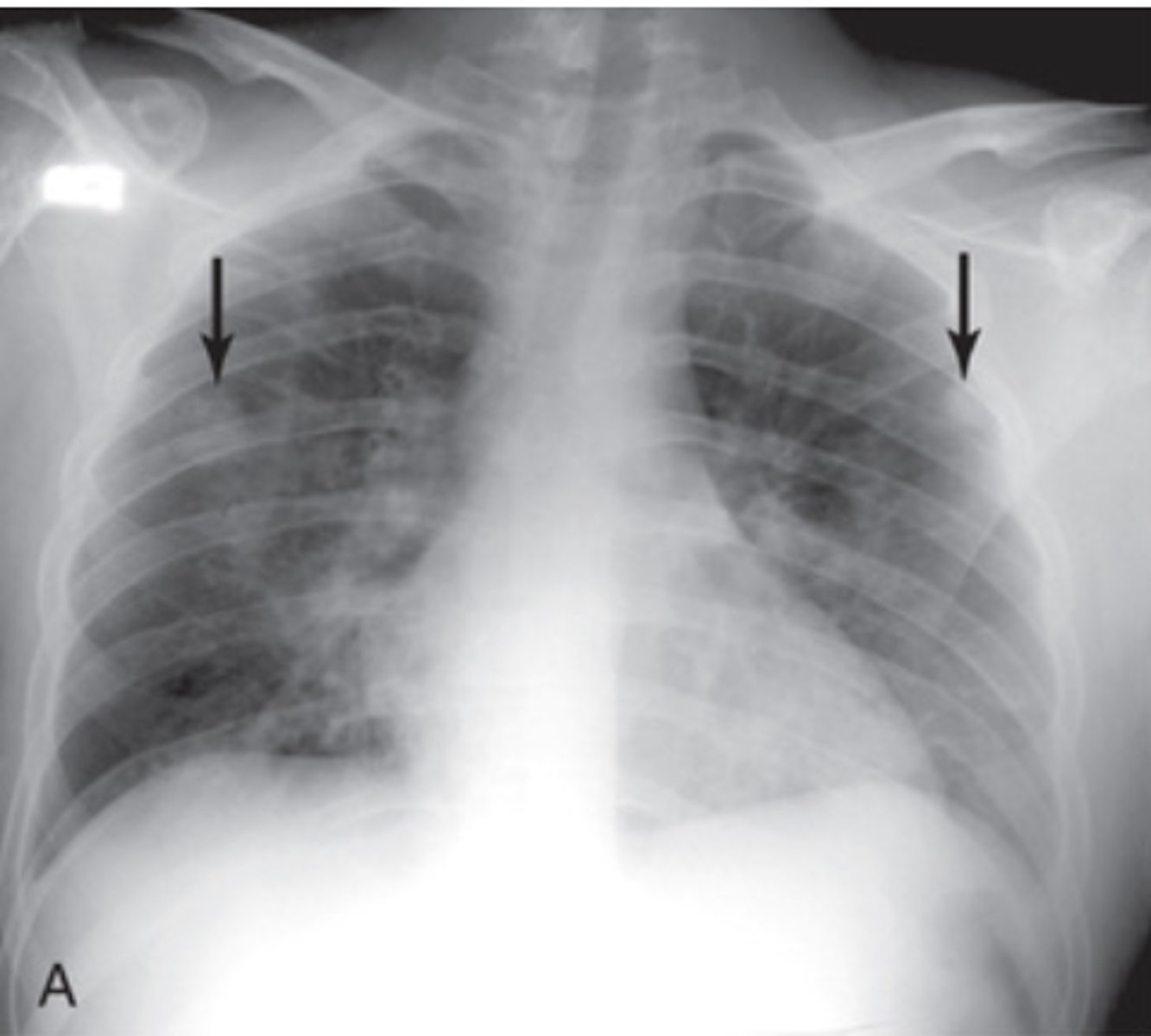 <p>ill-defined pulmonary nodules that can cavitate</p>
