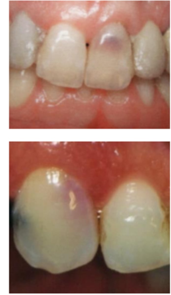 <p>Patient presents asymptomatic with a normal appearance but there is a pink/red spot on the tooth, what is the most likely diagnosis?</p>