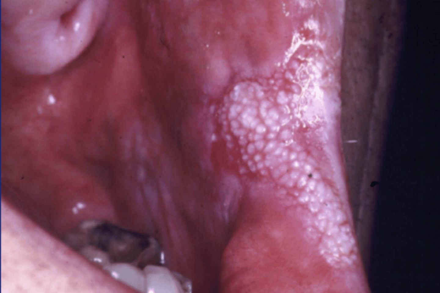 <p>white plaque with red component</p><p>• unknown cause</p><p>• must biopsy after 14 days</p><p>• population: males over 50</p>