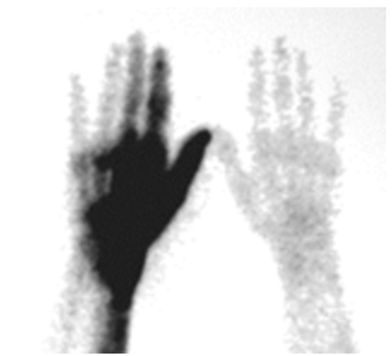 <p>the hand on the left side of the screen is on an arm where the radiopharmaceutical was injected into an artery instead of a vein</p>