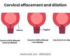 <p>Thining of cervix</p><p>0%-100%</p>