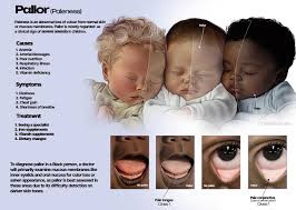 <ol><li><p>light skin - paleness of the skin, nail bed and mucous membrane</p></li><li><p>dark skin - gray or ashen appearance on dark brown to black skin and yellow-ish on brown skin</p></li></ol><p></p>