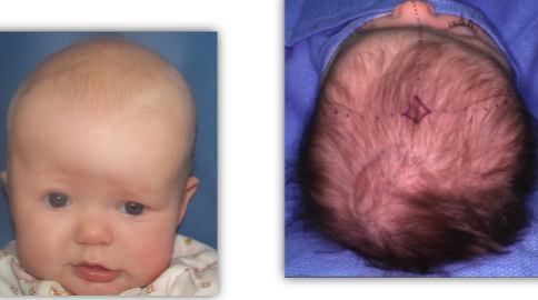 <ul><li><p>ridged ossification of affected coronal suture </p></li><li><p>frontal bone asymmetry </p></li><li><p>superior orbit/sphenoid asymmetry, eye appears larger on effected side </p></li><li><p>frontal bossing of non-affected side </p></li><li><p>root of nose deviates to non-affected side </p></li></ul><p></p>