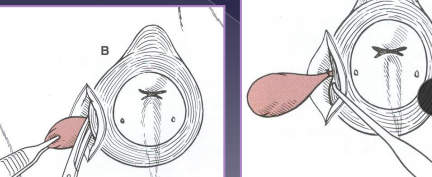 <p><span>Closed anal sacculectomy</span></p>