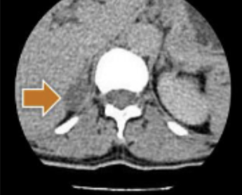 <p><span style="color: rgb(149, 106, 106)">CT adrenals </span><span style="color: #000000">scan 3</span></p>