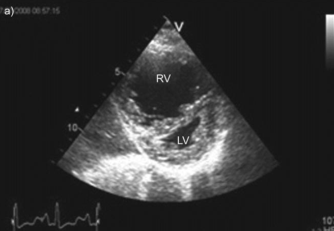 <p><span>You scan a patient and in the PSAX view we see this image in both systole and diastole.&nbsp; We would expect this patient to be experiencing</span></p><p></p><p>Tricuspid stenosis</p><p></p><p>RVH</p><p>&nbsp;</p><p>Volume overload</p><p>&nbsp;</p><p>Pressure overload</p>