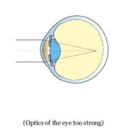 <p>optics of the eye too strong but length is normal </p><p>can cause cornea to be more curved and a denser lens </p>