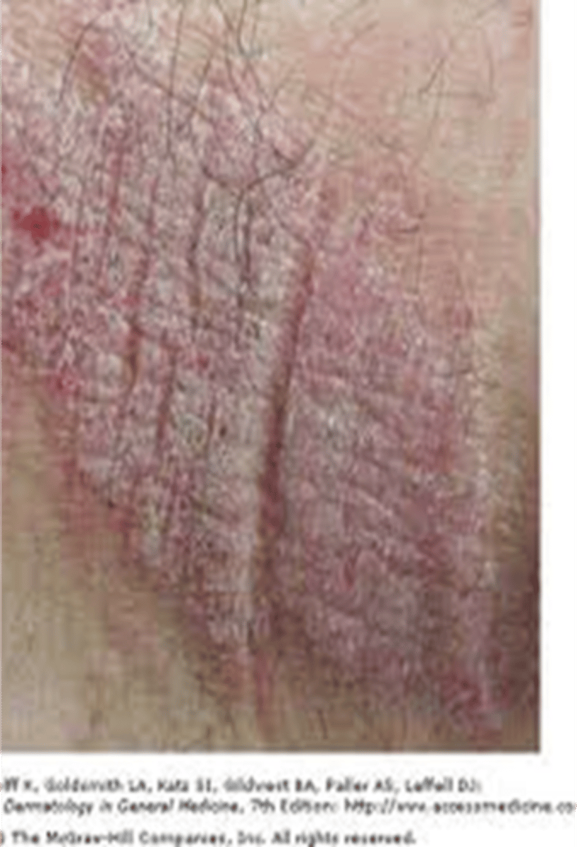 <p>____________ – the surface is rough &amp; thickened</p><p>•Accentuates the normal skin lines</p><p>•Resembles a tree bark</p>