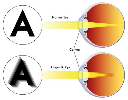 <p>Uneven curvature of the lens or cornea resulting in distorted images</p>