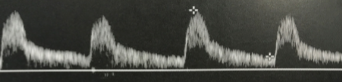 <p>This waveform was dopplered at the vertebral artery.&nbsp;</p><ol><li><p>Does this waveform appear normal or abnormal?</p></li><li><p>If abnormal, explain why. </p></li></ol><p></p>