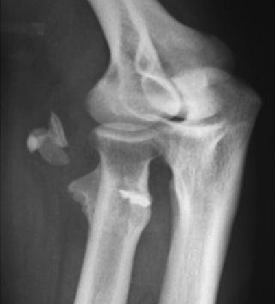 <p>Heterotopic Ossificans (bone growth in muscle) is Ectopic bone formation in para-articular soft tissues, it has unknown etiology but high risk how long after trauma?</p>
