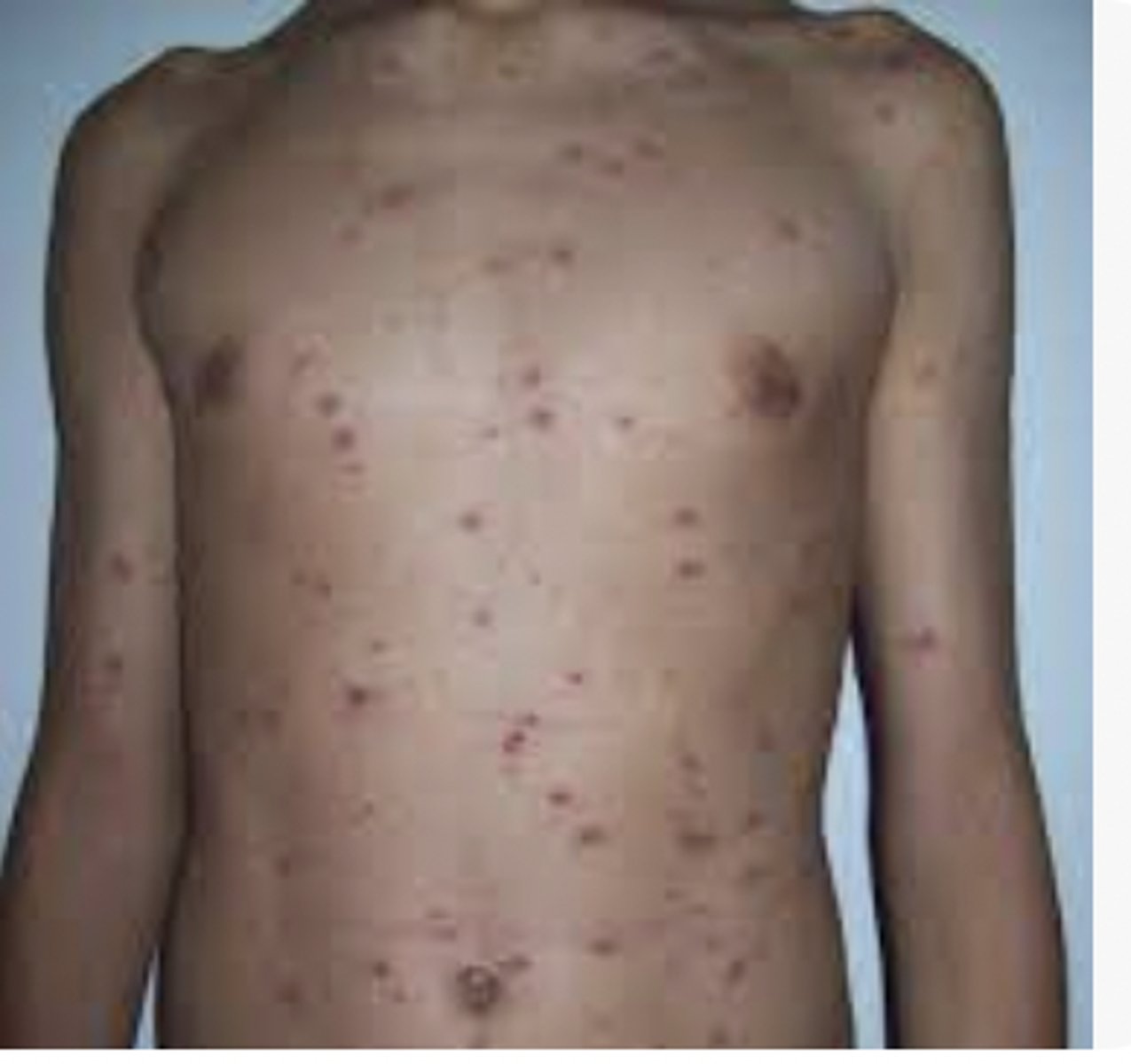 <p>superficial lesions in centripetal distribution, no prodromal fever</p>