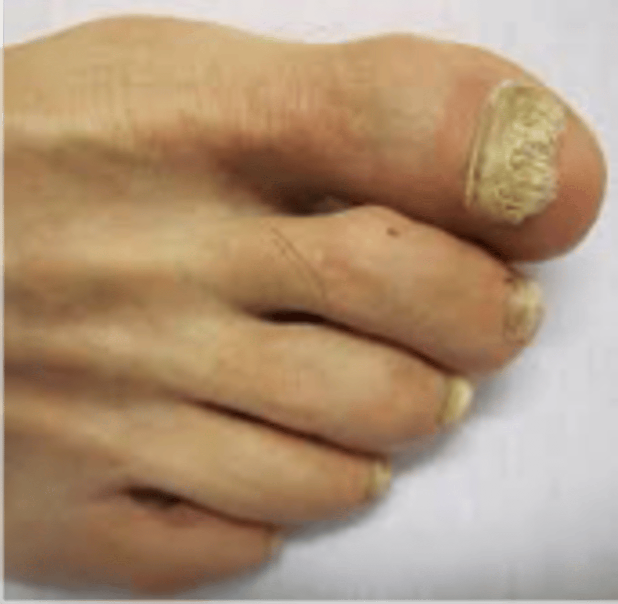 <p>◦Thickened yellow hypertrophic nail growth due to fungal infection</p>