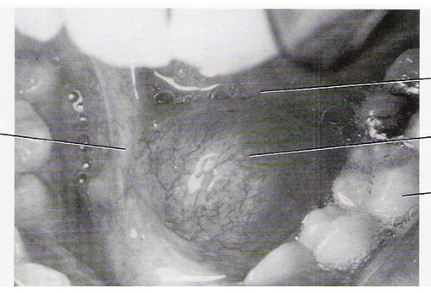 <p>Obstruction or injury to the submandibular or sublingual duct causing unilateral swelling on the floor of the mouth.</p>