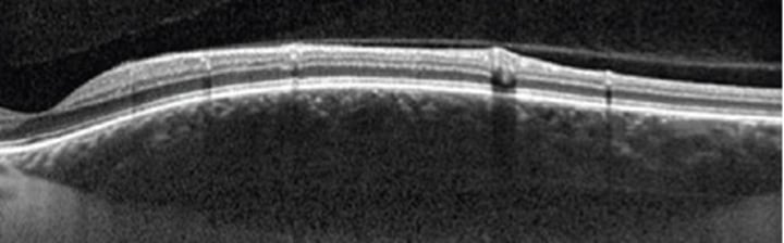 <p>Dome shaped --&gt; does not compress the choriocapillaris</p>