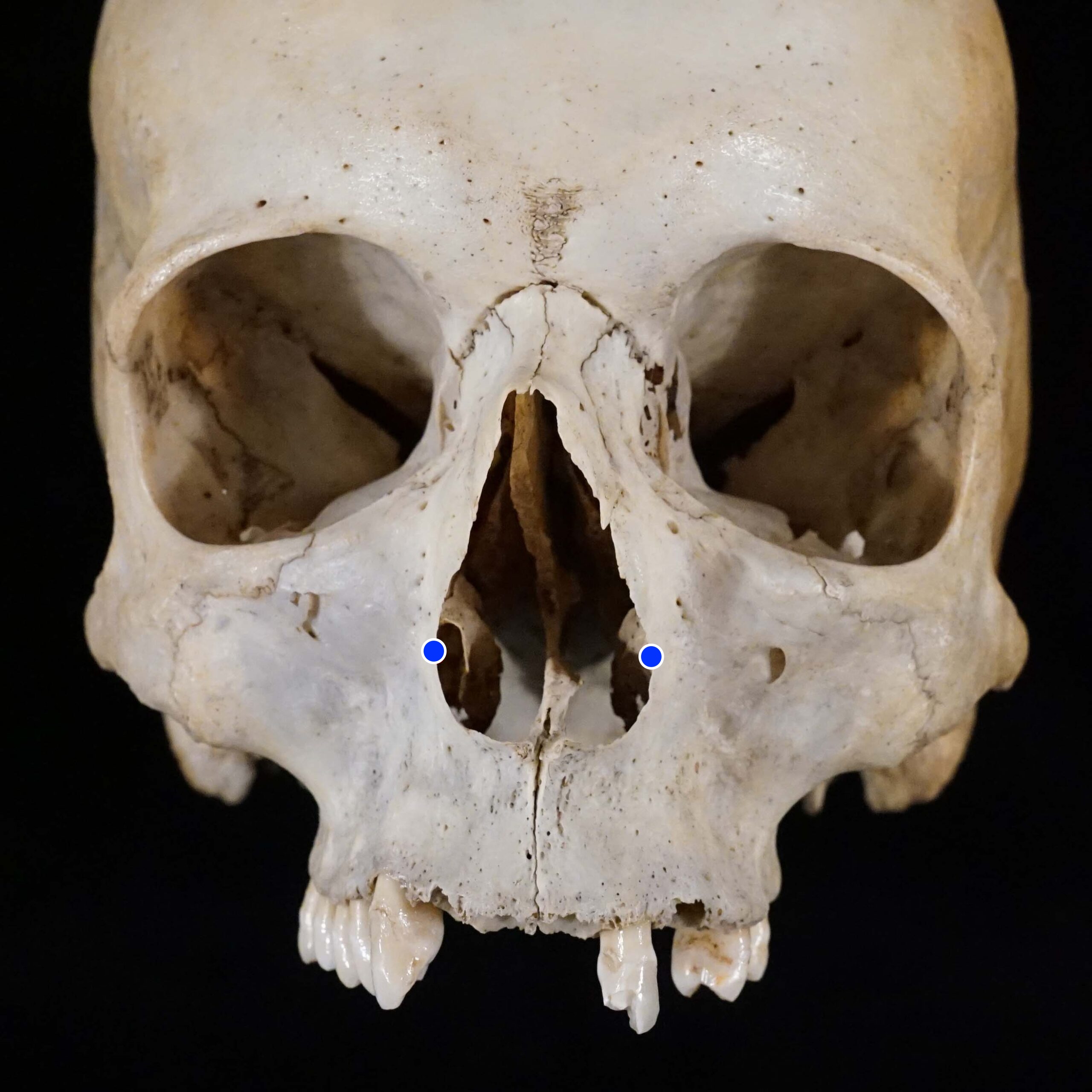 <p>Most lateral point on margin of anterior nasal aperture</p>