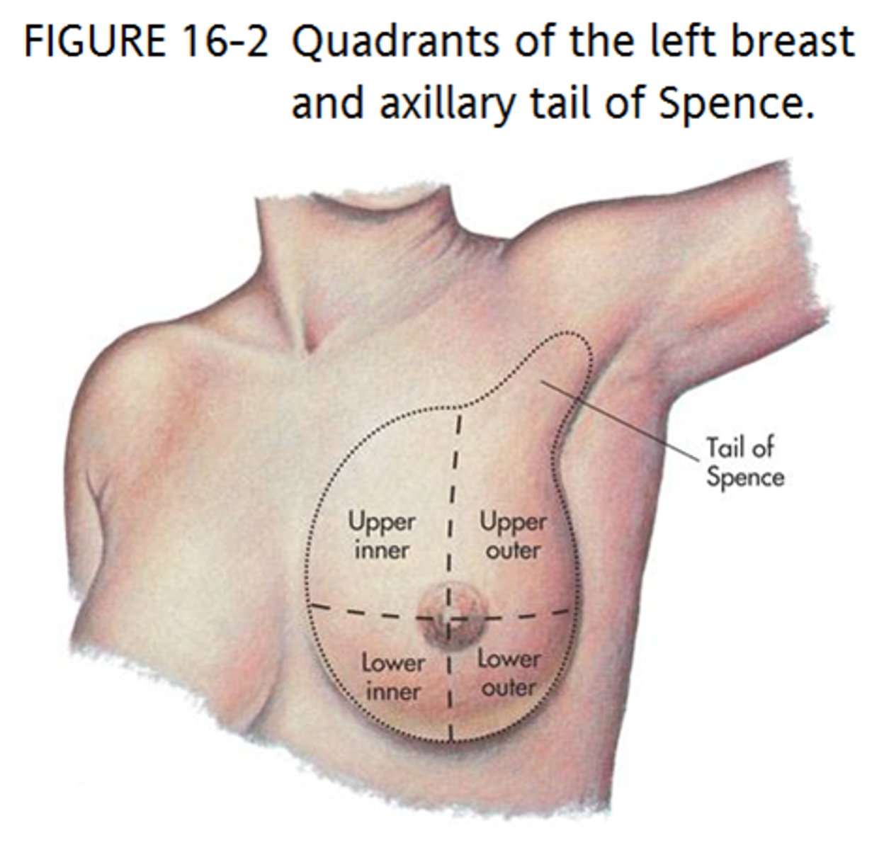 <p>extension of breast tissue into the axilla</p>