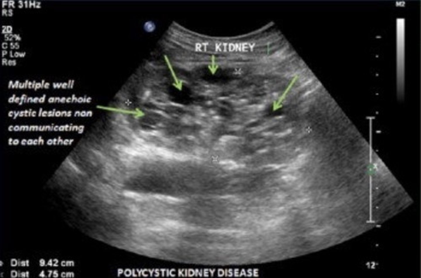<p>Bilateral large cysts</p><p>Large kidneys</p><p>Hyperechoic parenchyma</p><p>Normal bladder/fluid levels</p>