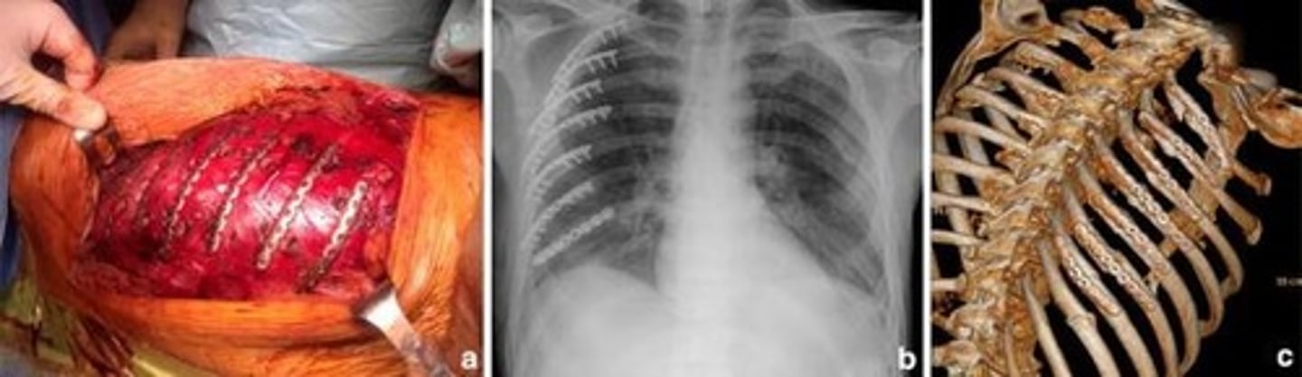 <p>The presence of air in the pleural space.</p>