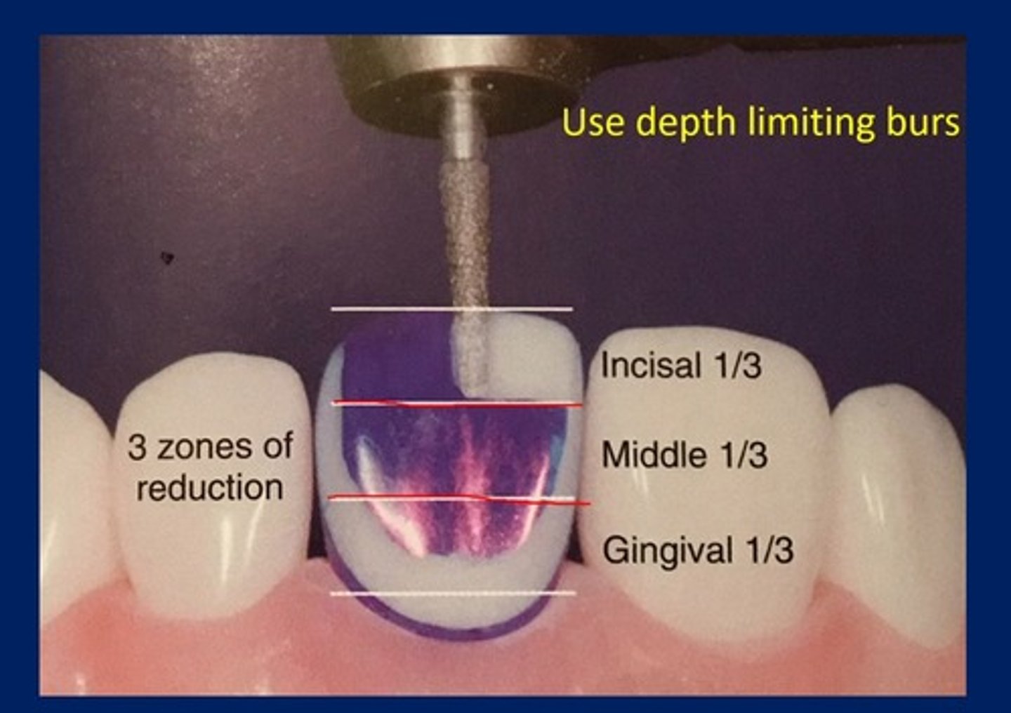 <p>use depth limiting burs to create depth cuts across the surface of the tooth before coming back with our round ended tappered diamond.</p>