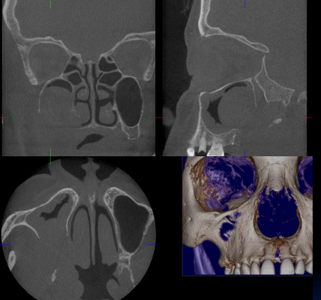 <p>-complete loss of inferior maxillary sinus → missing bone</p><p>-think cancer until proven otherwise</p>
