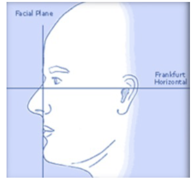 <p>Reference plane from the superior border of the external auditory meatus to the infraorbital border.</p>