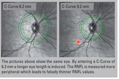 <p>scan capture issue: improper correction for corneal curvature </p>