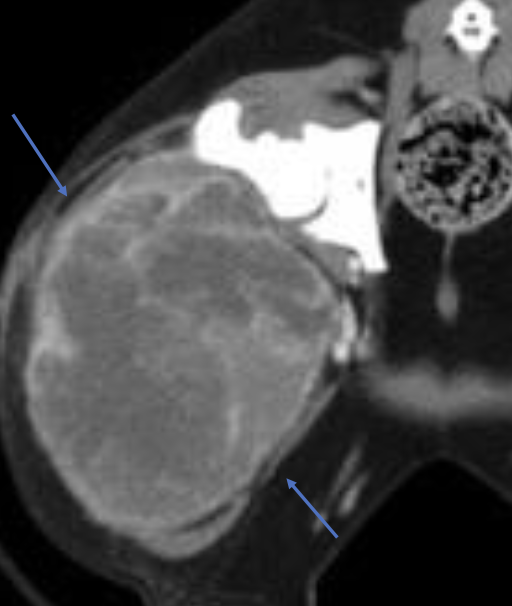 <p>stage 1: strictly dermal</p><p>stage 2: hypodermal/SQ</p><p>stage 3: intramuscular</p>