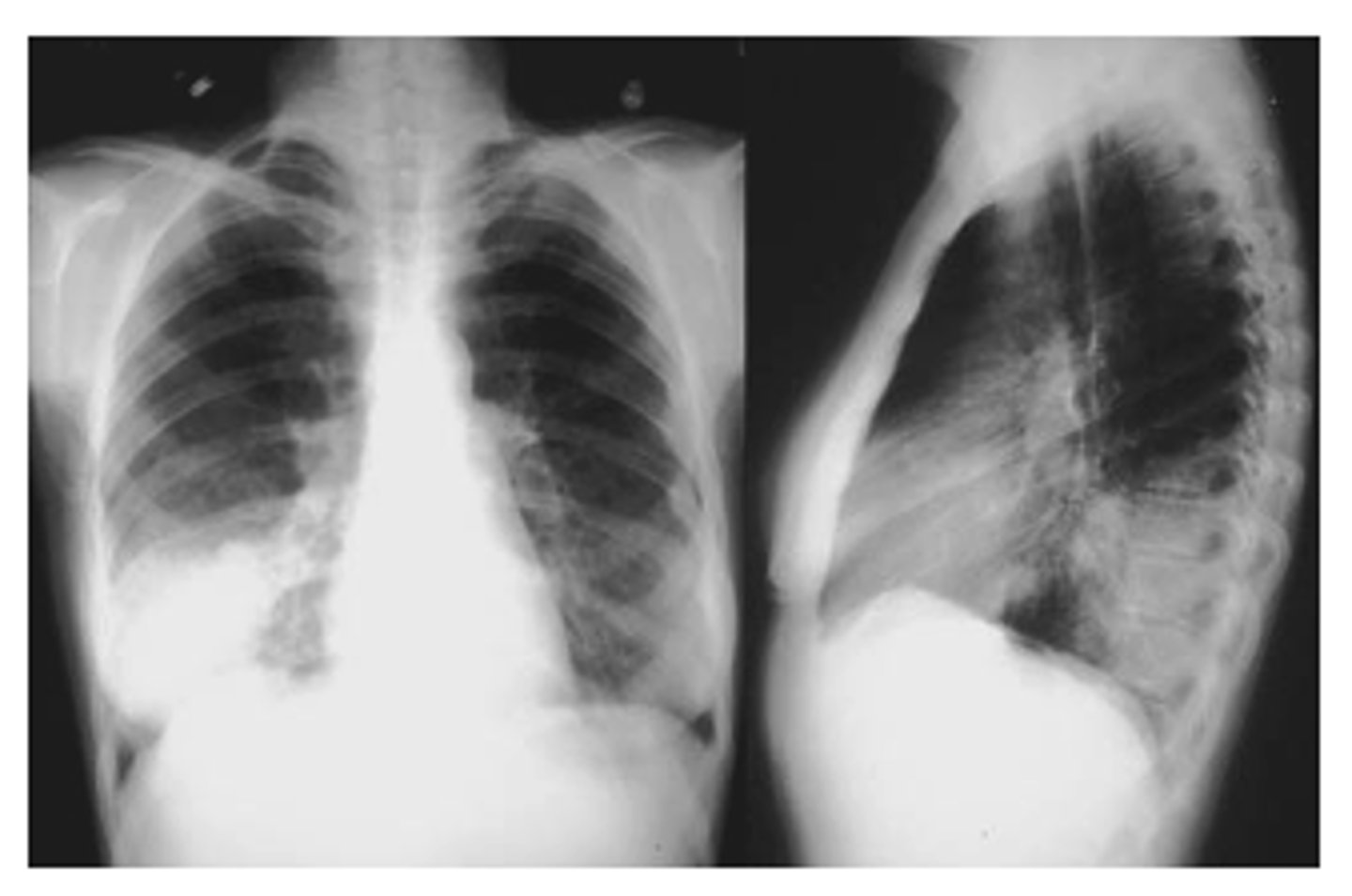 <p>oHelps determine the location of an abnormality in comparison to normal anatomy.</p><p>oLoss of a normal border and contour occurs if there is an abnormality contiguous with that structure (next to)</p><p>EX: if the R cardiac border is obscured, then the infiltrate must be in the medial segment of the R middle lobe.</p><p>(pic also has spine sign)</p>