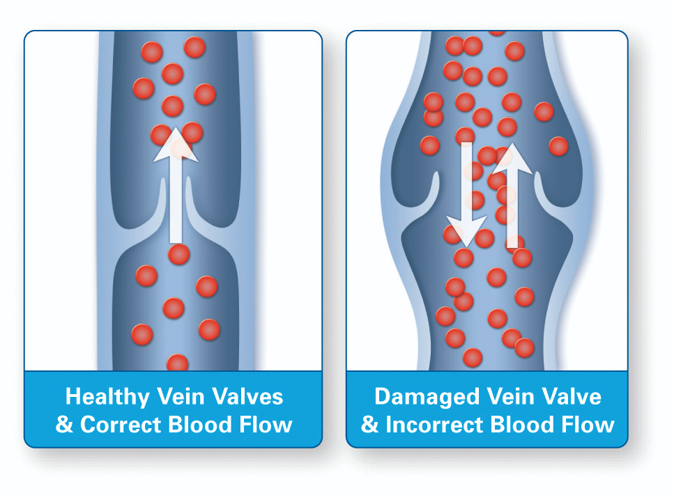 <p>Veins contain <strong>numerous valves</strong> projecting into lumen to prevent backflow due to low pressure.</p><ul><li><p>only in veins NOT arteries!</p></li></ul><p></p>