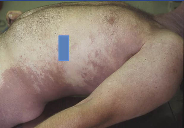 <p><span><span>Postmortem hypostasis</span><span><br></span><span> Accumulation of blood</span><span><br></span><span>in small vessels</span><span><br></span><span> Dependent on gravity</span><span><br></span><span> Can be misinterpreted</span><span><br></span><span>as bruising</span><span><br></span><span> Reddish-purple</span><span><br></span><span>(dependent on body</span><span><br></span><span>pigmentation)</span></span></p><p><span><span>Blanched areas =</span><span><br></span><span>pressure from position</span><span><br></span><span>or clothing</span><span><br></span><span> Evident within ½ to 2</span><span><br></span><span>hrs after death</span><span><br></span><span> Maximal at 8 – 12 hrs</span><span><br></span><span> “fixed lividity” – test by</span><span><br></span><span>applying pressure</span><span><br></span><span> Has the body been</span><span><br></span><span>moved?</span></span></p><p><span><span>Darkest in areas most</span><span><br></span><span>gravitationally</span><span><br></span><span>dependent (ie, lower)</span><span><br></span><span>• Pale (blanched) areas</span><span><br></span><span>where body pressed</span><span><br></span><span>against surface or</span><span><br></span><span>object</span><span><br></span><span>• Difficult to assess in</span><span><br></span><span>darkly pigmented</span><span><br></span><span>individuals</span><span><br></span><span>• Early (blanchable) – can</span><span><br></span><span>shift if body is</span><span><br></span><span>moved/turned</span><span><br></span><span>• Advanced (fixed) – can</span><span><br></span><span>develop pinpoint</span><span><br></span><span>hemorrhages (Tardieu</span><span><br></span><span>spots)</span><span><br></span><span>• May show in internal</span><span><br></span><span>organs as well</span><span><br></span><span>(posterior more</span><span><br></span><span>congested with blood)</span></span></p>