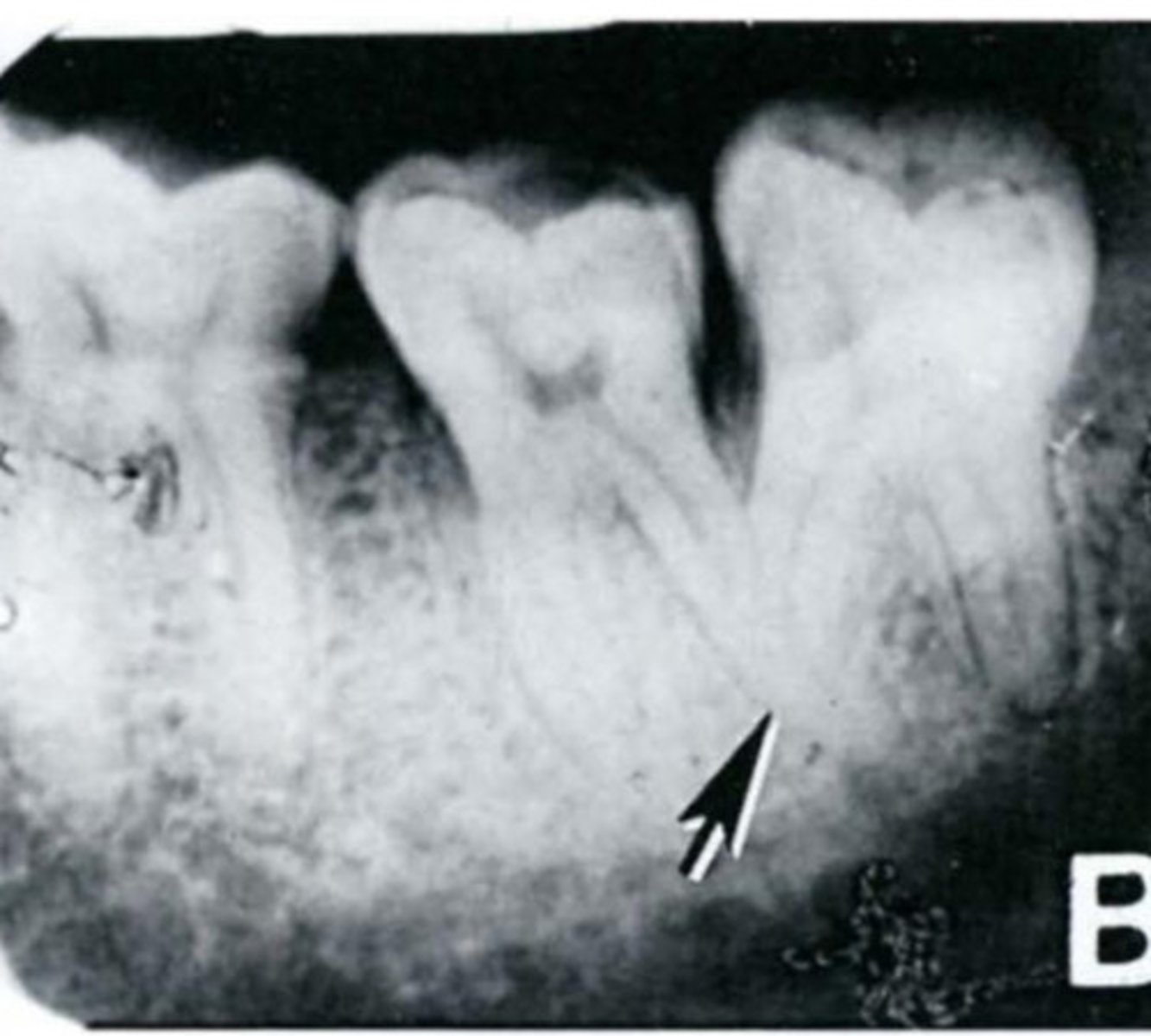 <p>Maxillary molars</p>