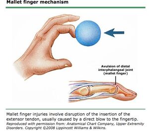 <p><span>-inability to extend DIP into full extension d/t tendon injury</span><br><span>-requires splinting of DIP into slight hyperextension for tendon repair</span></p>