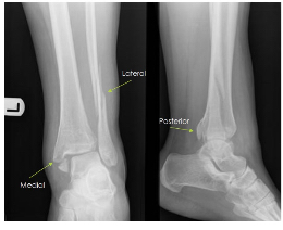 <p>What fracture is this? </p>