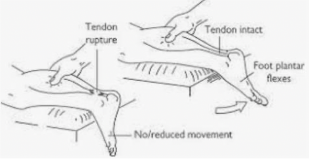 <p>47 y/o male tennis player presents to the ER with ankle pain. He states that he was playing in an ametuer tennis tournament when he felt a pop in his ankle. On physical exam you note a palpable gap over the achilles tendon, a loss of resting foot tone, weakness to plantarflexion, and a positive thompson test. What is your game plan?</p>