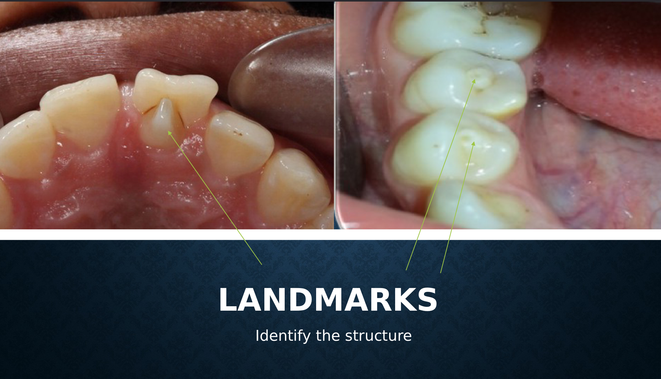 <p>accessory cusps. overcalcification small elevation of enamel</p>