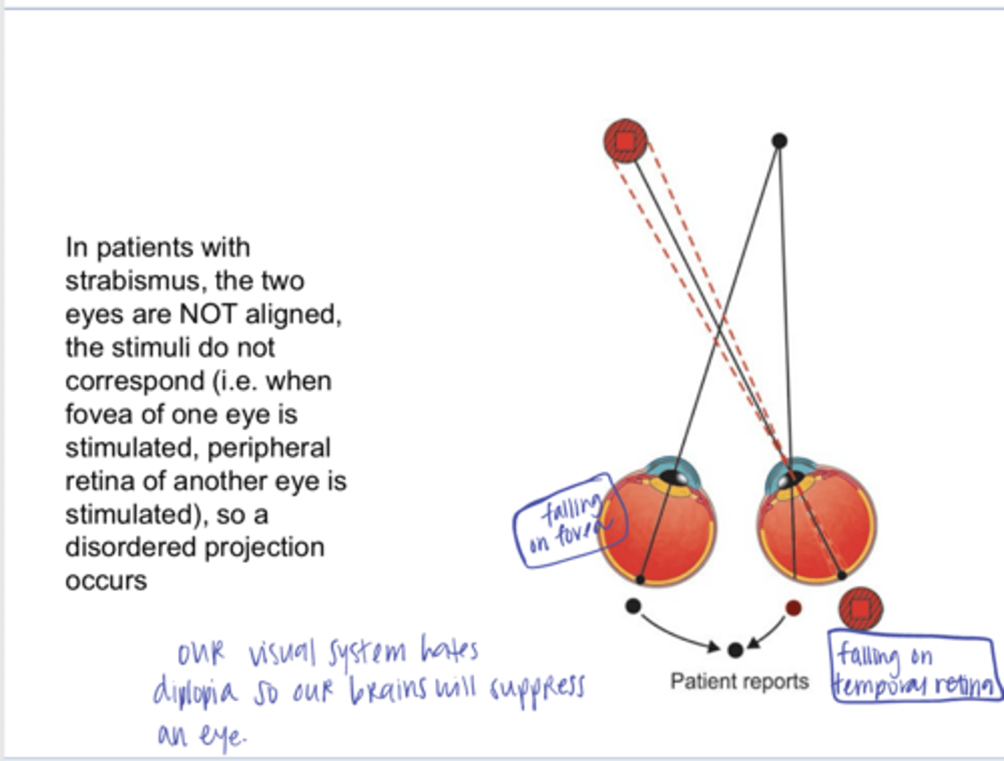 <p>In patients with strabismus the two eyes are NOT ALIGNED, what are the consequences of this?</p>