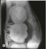 <p>Where does the buccal bifurcation cyst typically develop?</p>