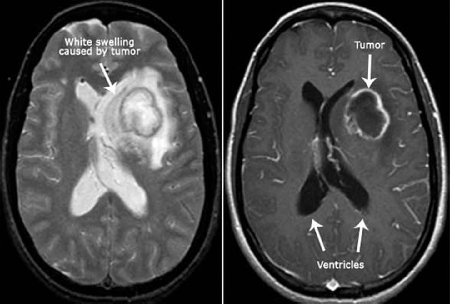 <p>malignant brain tumor arising from glial cells</p><p>- worst form</p><p>- stage 4 astrocytoma</p>