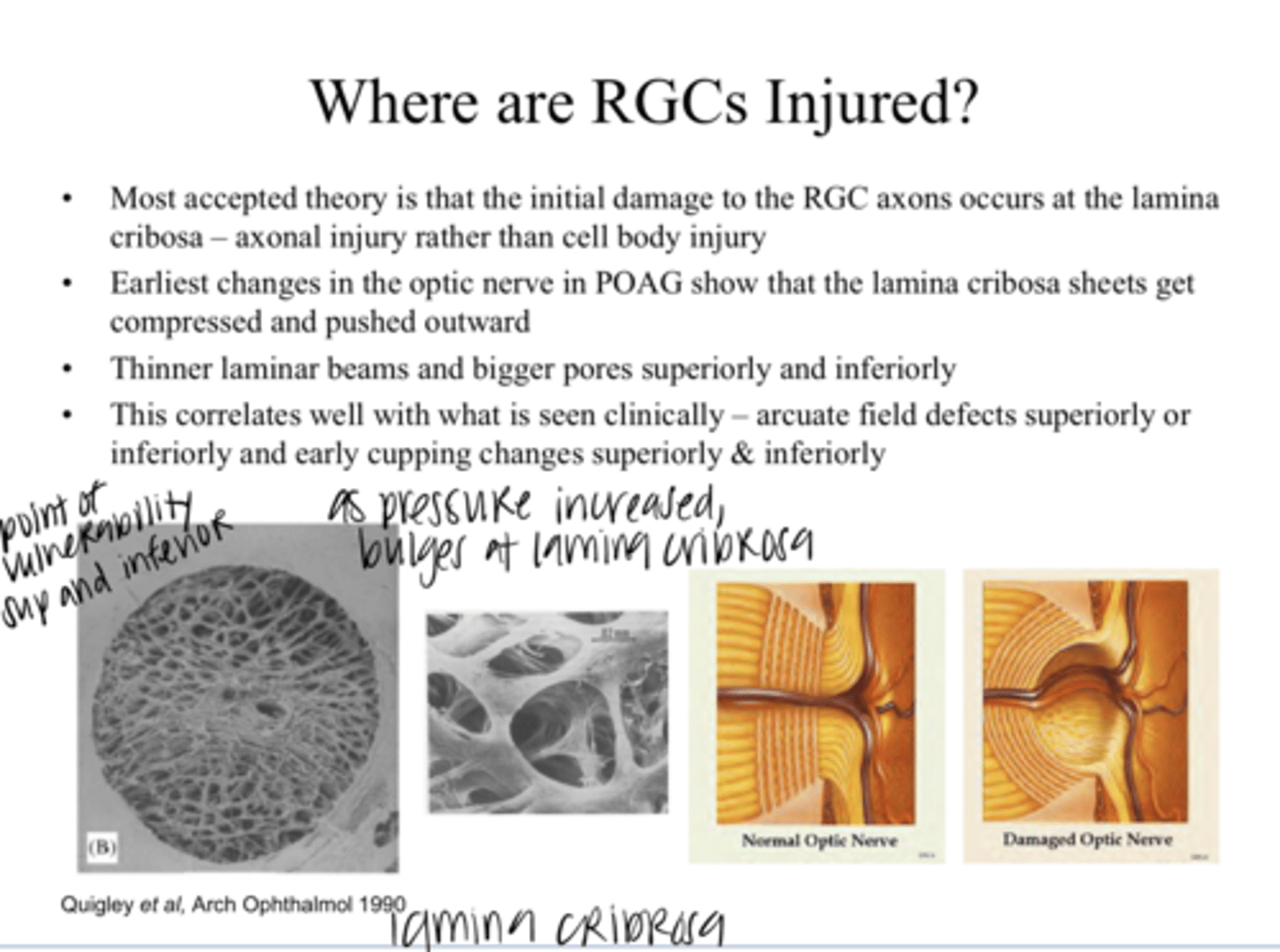 <p>Earliest changes in the optic nerve in POAG show what happening to the lamina cribosa?</p>