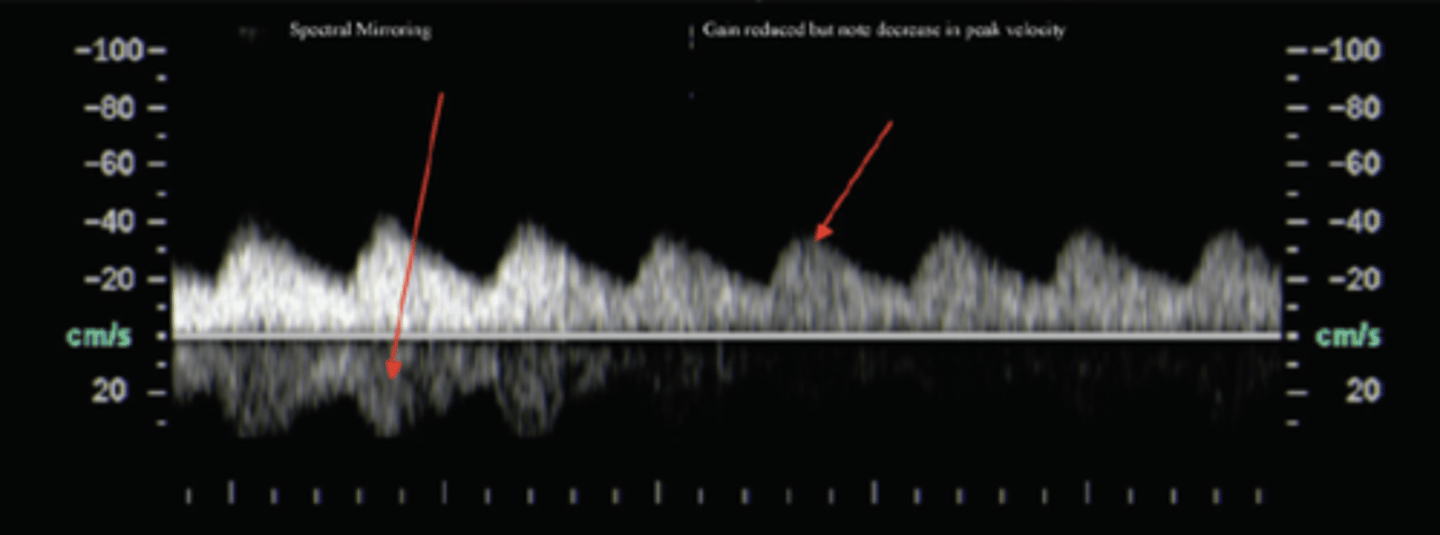 <p>Presence of flow on both sides of baseline</p><p>False flow is usually less amplified and will be the mirror image of true flow</p>