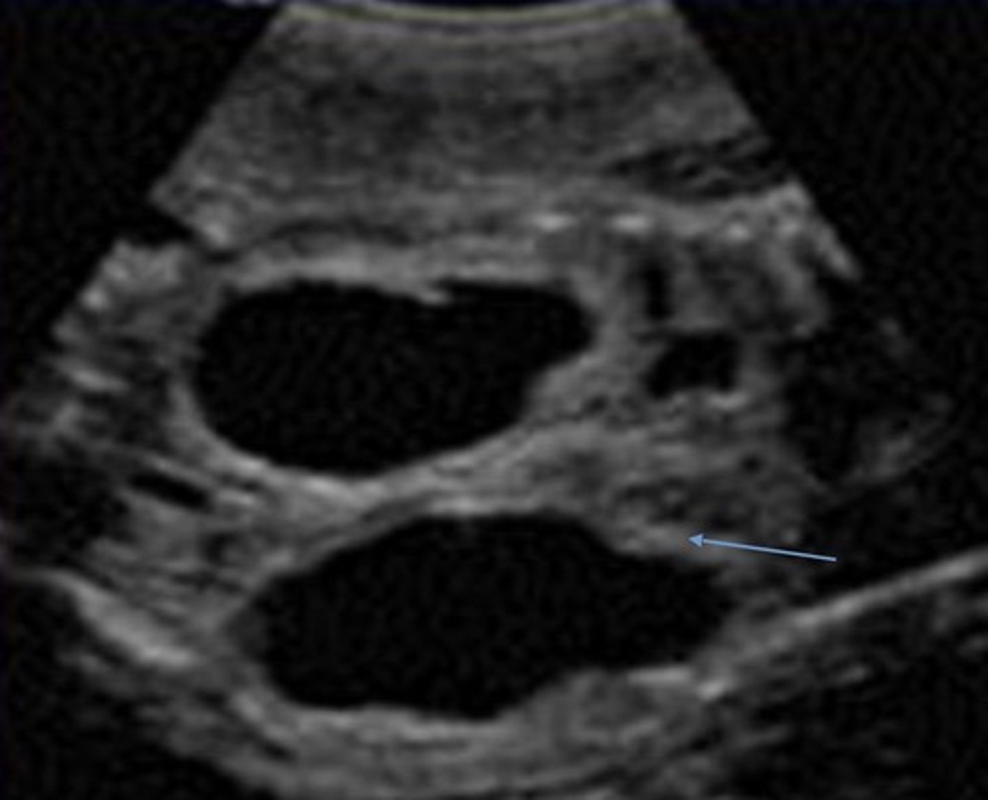 <p>Pelvis is > 10 mm</p><p>Marked dilation of calyces</p><p>Severe thinning of cortex</p>
